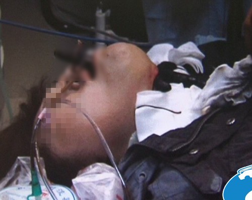 受伤女生连人带铁门的一部分躺在医院病床接受治疗