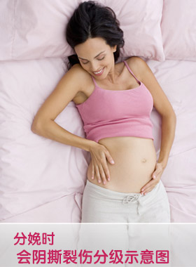 分娩时 会阴撕裂伤分级示意图