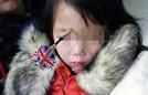 哥哥飞镖不慎扎妹妹眉心